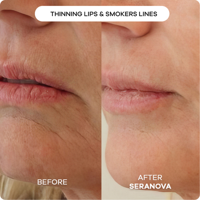 Microneedling Infusion System™