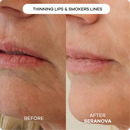 Microneedling Infusion System™