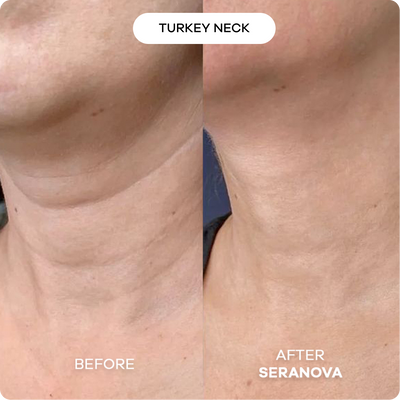 Microneedling Infusion System™
