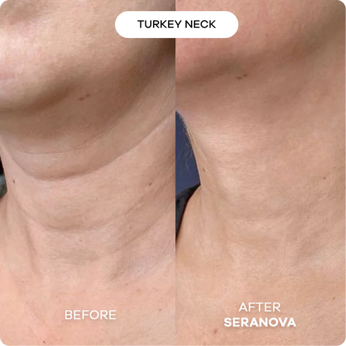 Microneedling Infusion System™