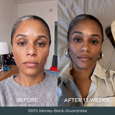 The Micro Infusion System™ Pigmentation For Melanin-Rich Skin