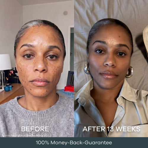 The Micro Infusion System™ Pigmentation For Melanin-Rich Skin