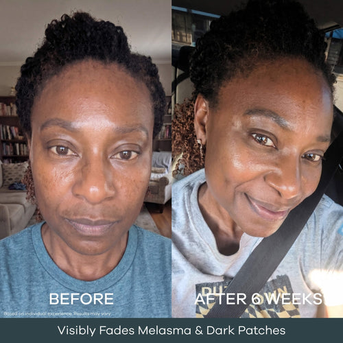The Micro Infusion System™ Pigmentation For Melanin-Rich Skin