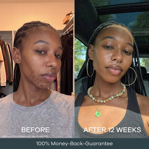 The Micro Infusion System™ Pigmentation For Melanin-Rich Skin