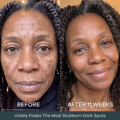 The Micro Infusion System™ Pigmentation For Melanin-Rich Skin