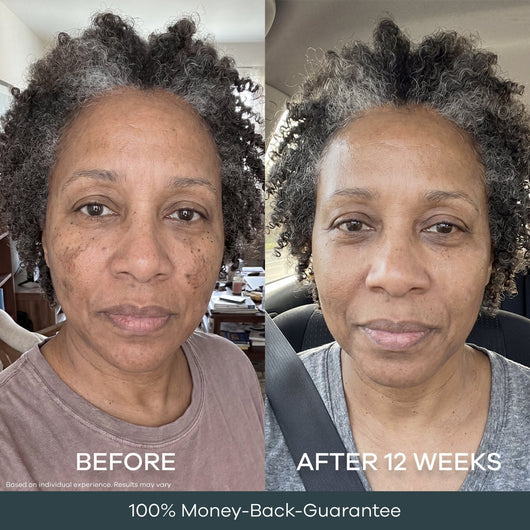 The Micro Infusion System™ Pigmentation For Melanin-Rich Skin